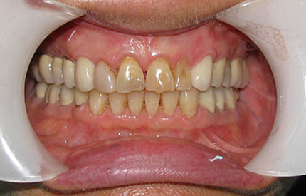 before dental treatment