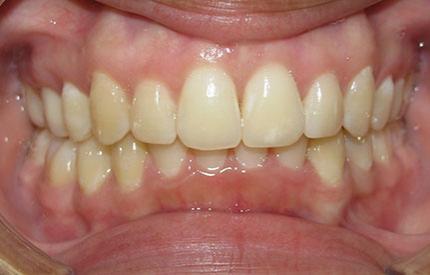after dental treatment
