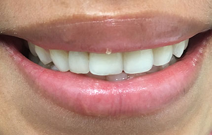 after dental treatment