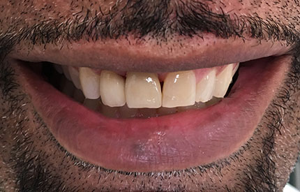 after dental treatment