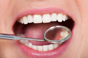 Dental hygienist examining healthy teeth and gums