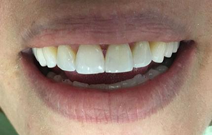 after dental treatment