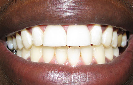 after dental treatment