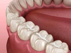 tooth-colored dental fillings