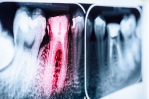 Dental X-ray