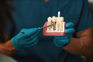 dental implants model