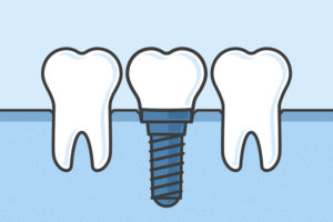 dental implants