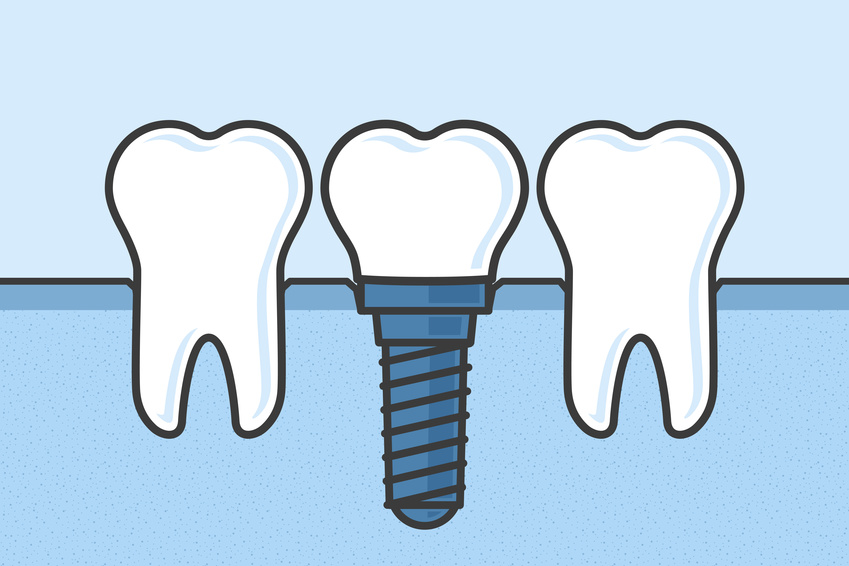 dental implants