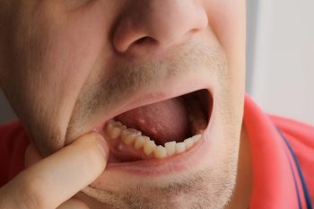 Man,Is,Showing,Tooth,In,Mouth,With,A,Dental,Abscess