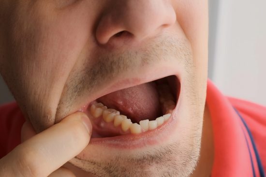 Man,Is,Showing,Tooth,In,Mouth,With,A,Dental,Abscess