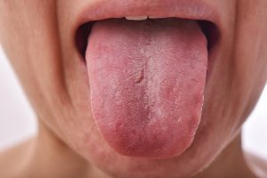 textured unhealthy tongue