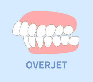 overjet
