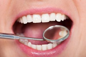 Close-up of a person's mouth with healthy, white teeth and a dental mirror for examination, illustrating dental care and cosmetic dentistry services related to dental bonding.