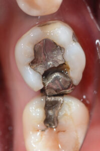 broken silver amalgam fillings 