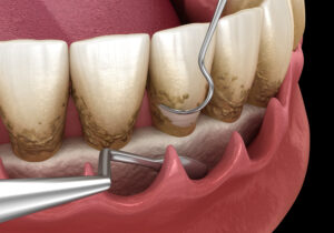 scaling and root planing for gum disease