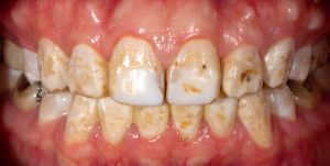 fluorosis