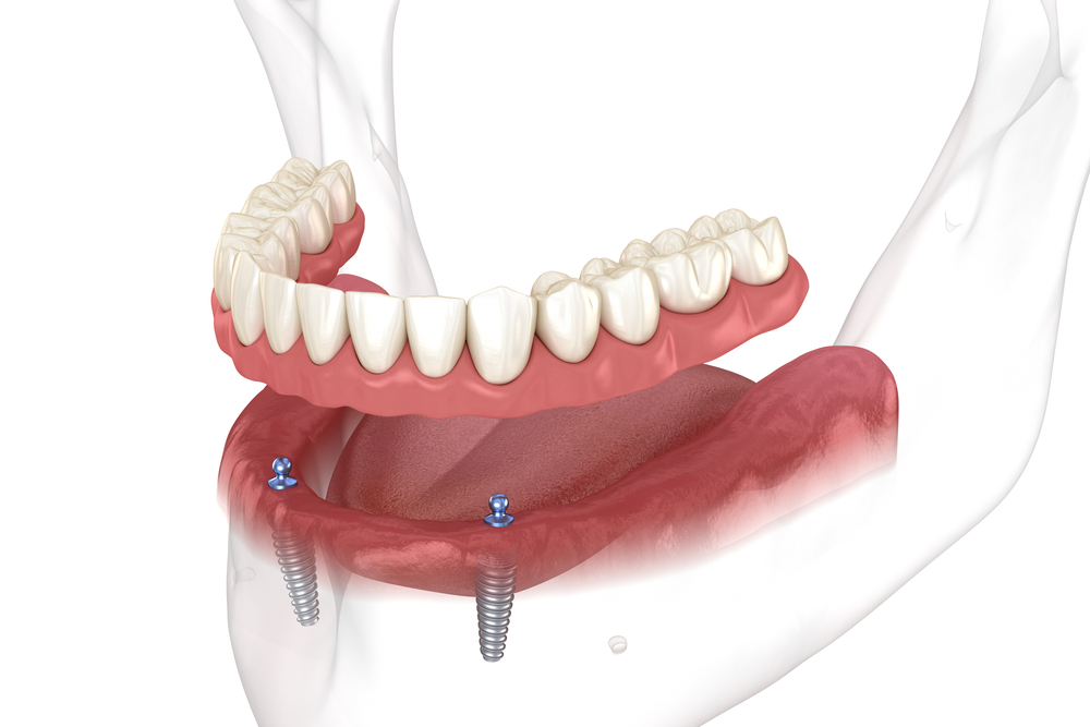 dental implant-supported denture