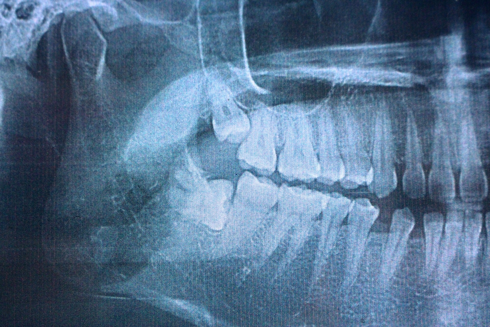 impacted wisdom teeth