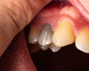 dark tooth in the mouth