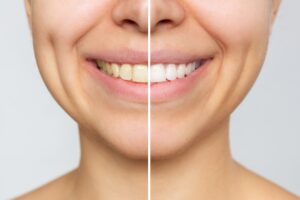 teeth whitening before and after