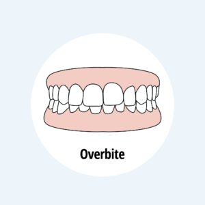 overbite