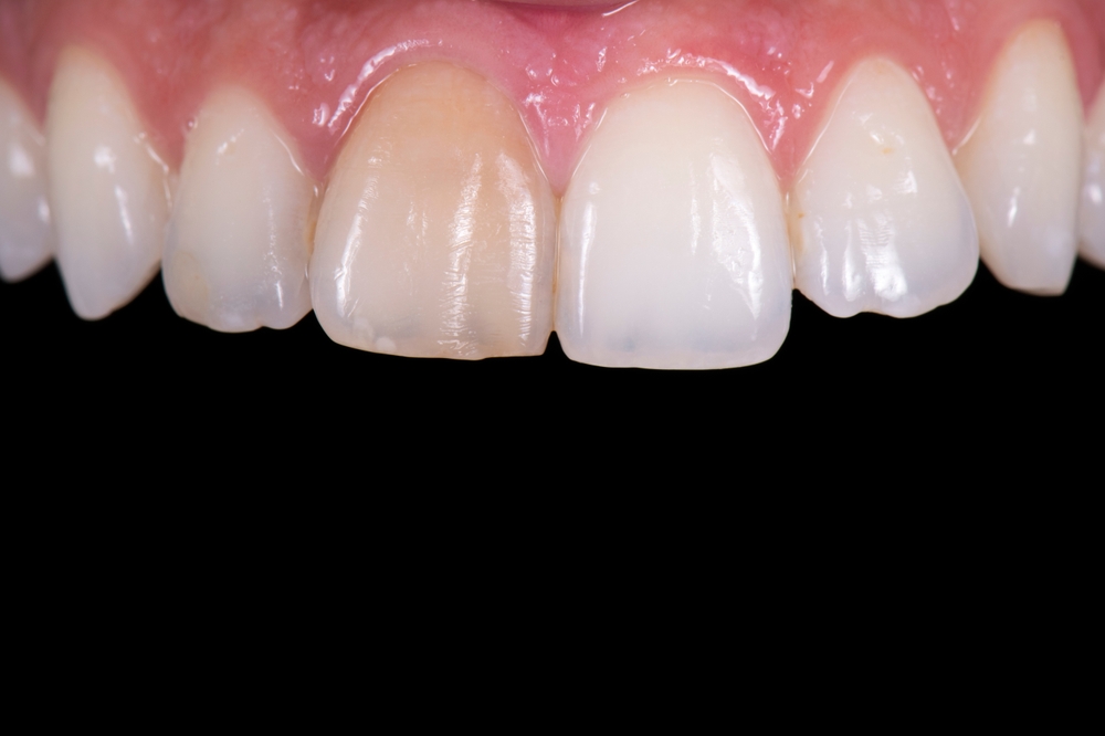 damaged, discolored front tooth