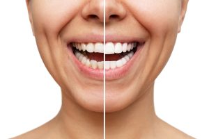 cosmetic dentistry before and after