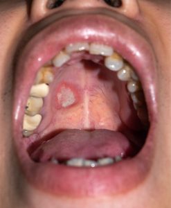 ulcer in the mouth, possible oral cancer symptoms