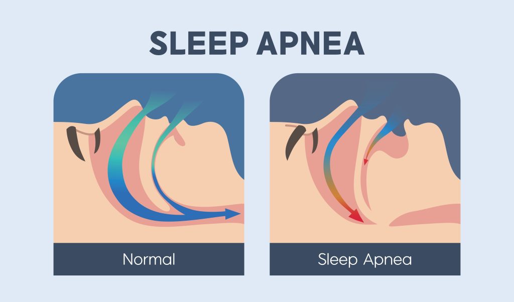 obstructive sleep apnea