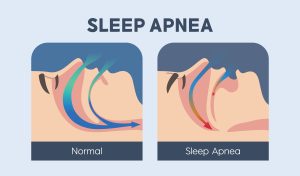 obstructive sleep apnea