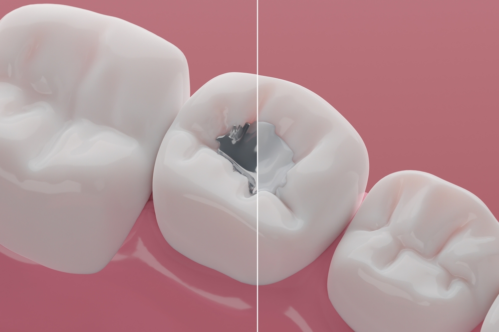 silver amalgam fillings compared to composite tooth-colored dental fillings