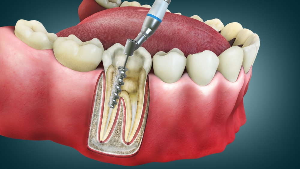 root canal treatment in Aventura, FL