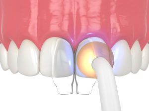 Dental bonding process with a curing light applied to composite resin between adjacent teeth, illustrating the hardening step in cosmetic dentistry.