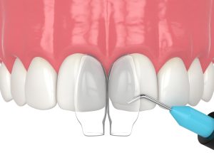 Dental bonding process illustration, featuring two front teeth with a dental tool applying composite resin for cosmetic enhancement.