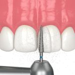 dental bond sculpting
