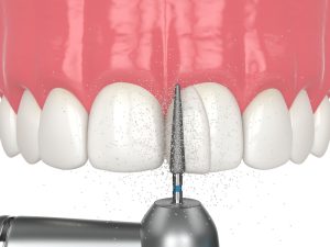 dental bond sculpting